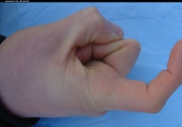 male forefinger bent left